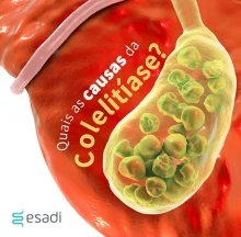 Quais as causas da colelitíase?