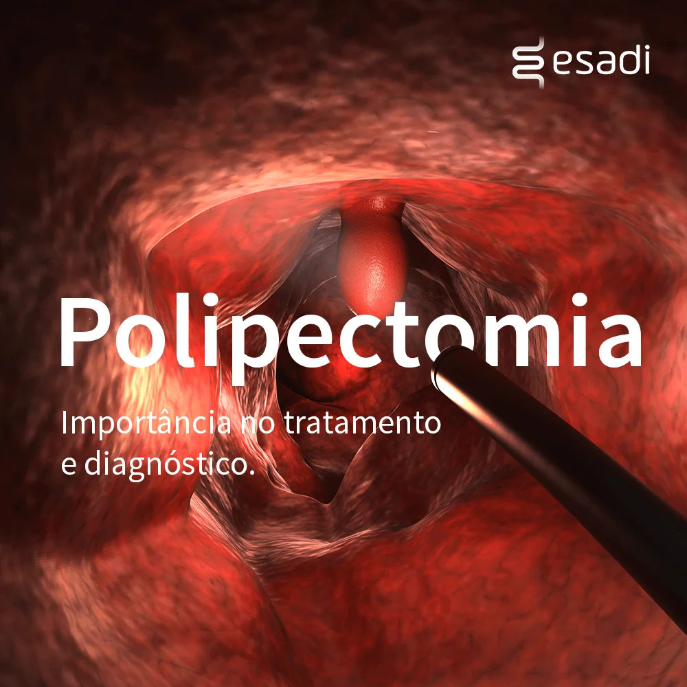 Polipectomia - Importância no tratamento e diagnóstico