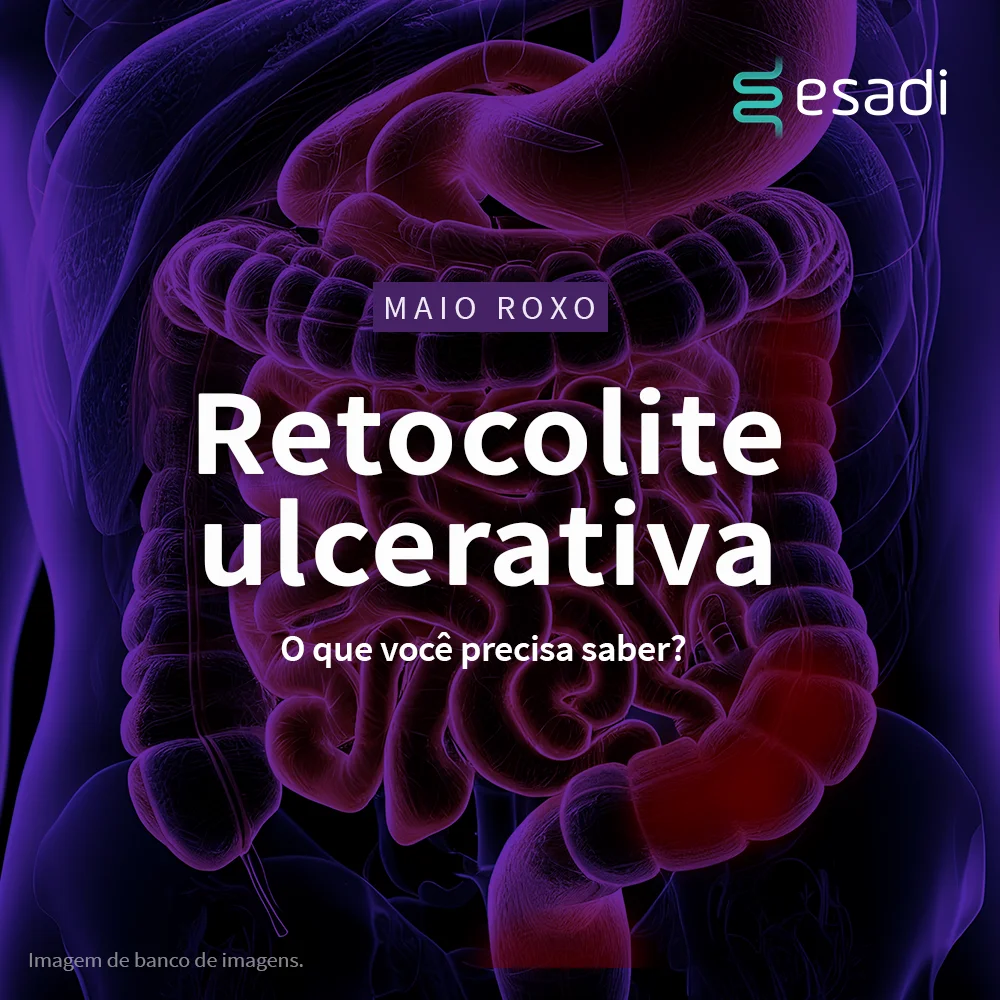 Retocolite ulcerativa tem características únicas e desafios no manejo clínico