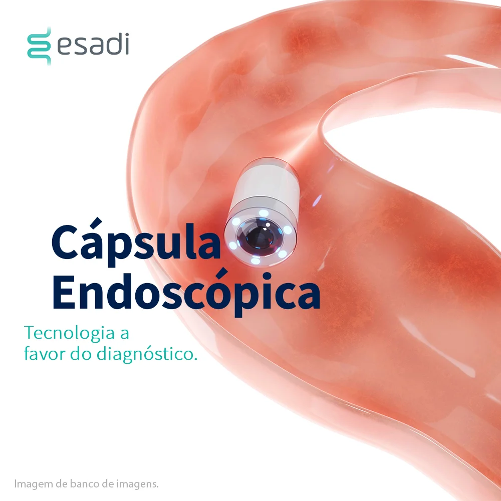 Cápsula Endoscópica - Tecnologia a favor do diagnóstico