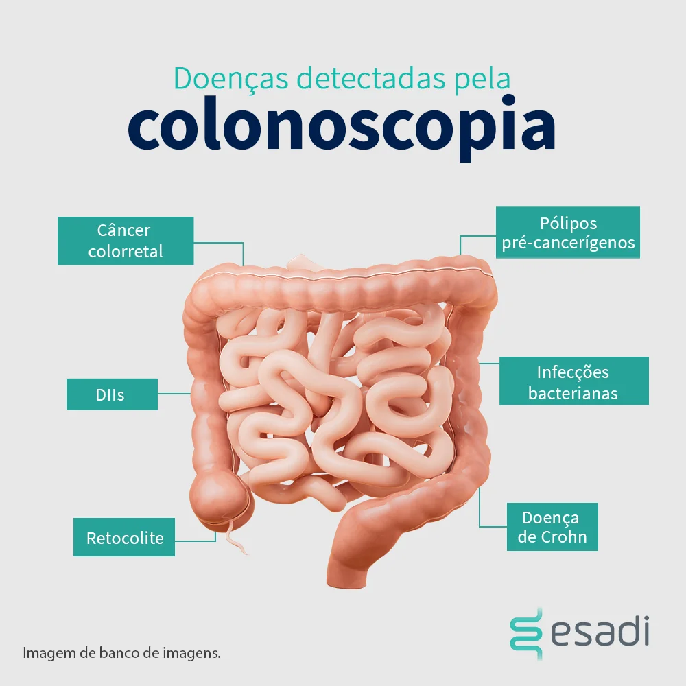 Doenças detectadas pela colonoscopia 