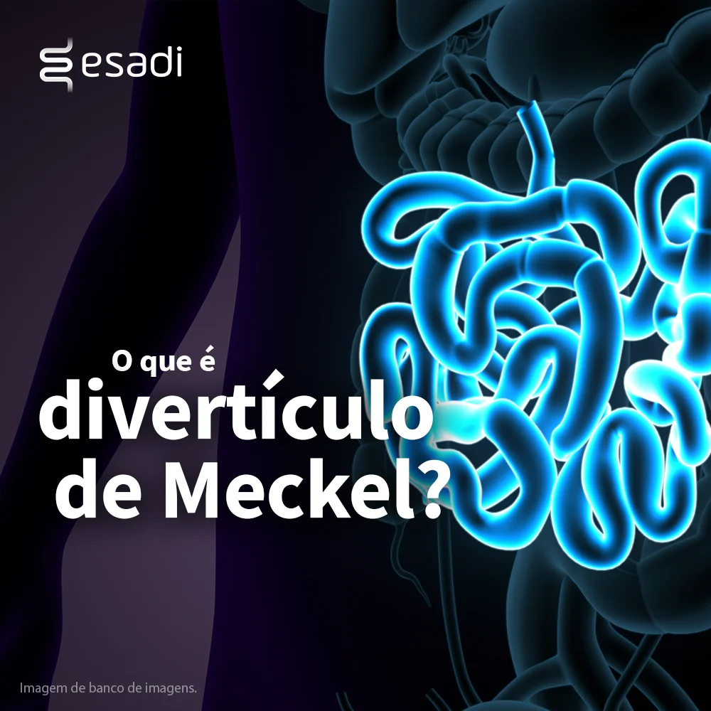 O que é divertículo de Merckel?