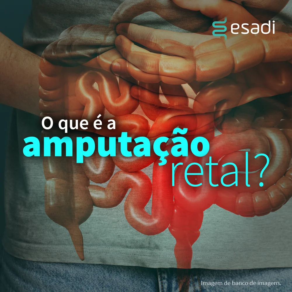 O que é a amputação retal?