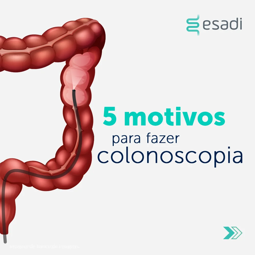 5 motivos para fazer colonoscopia