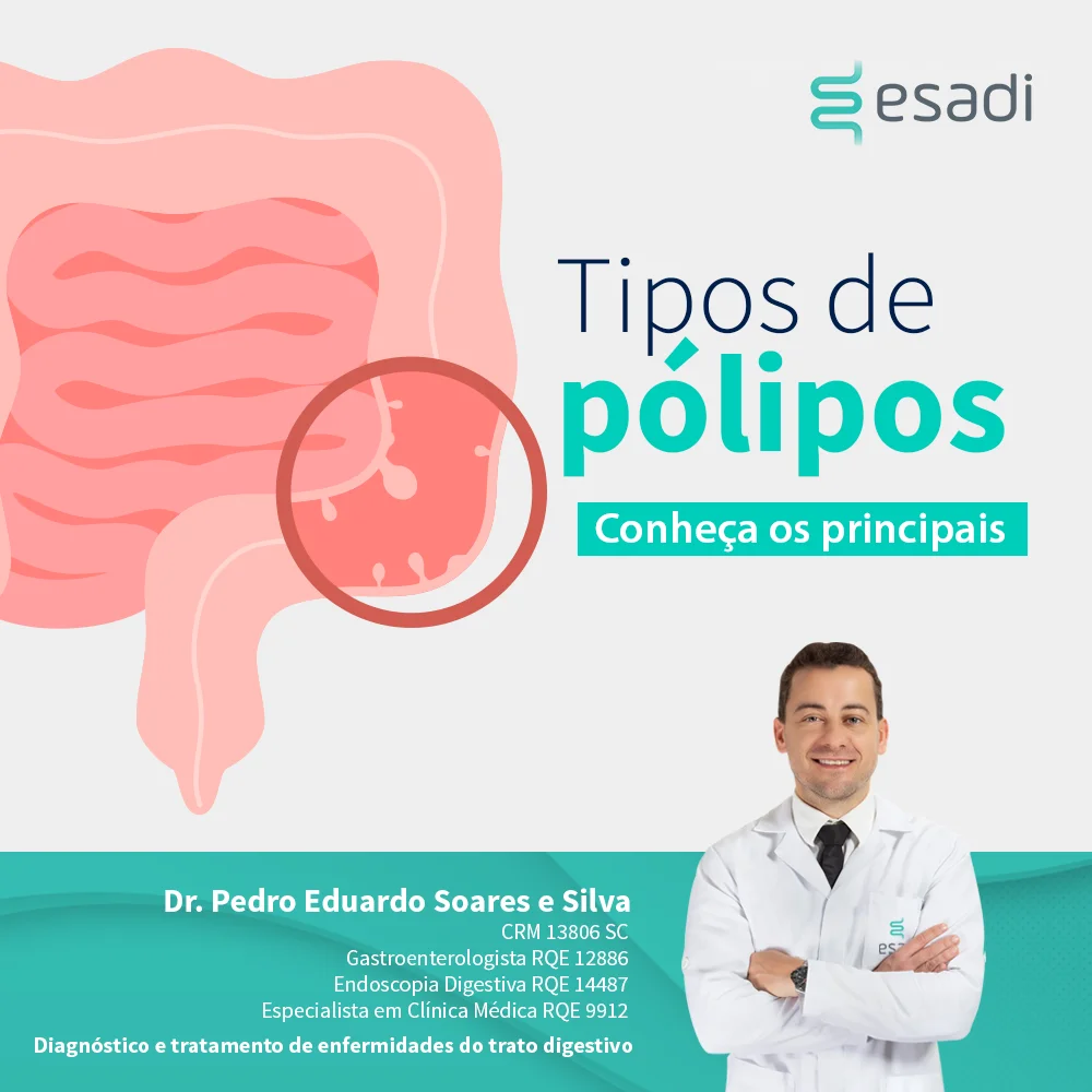 Tipos de pólipos - Conheça os principais