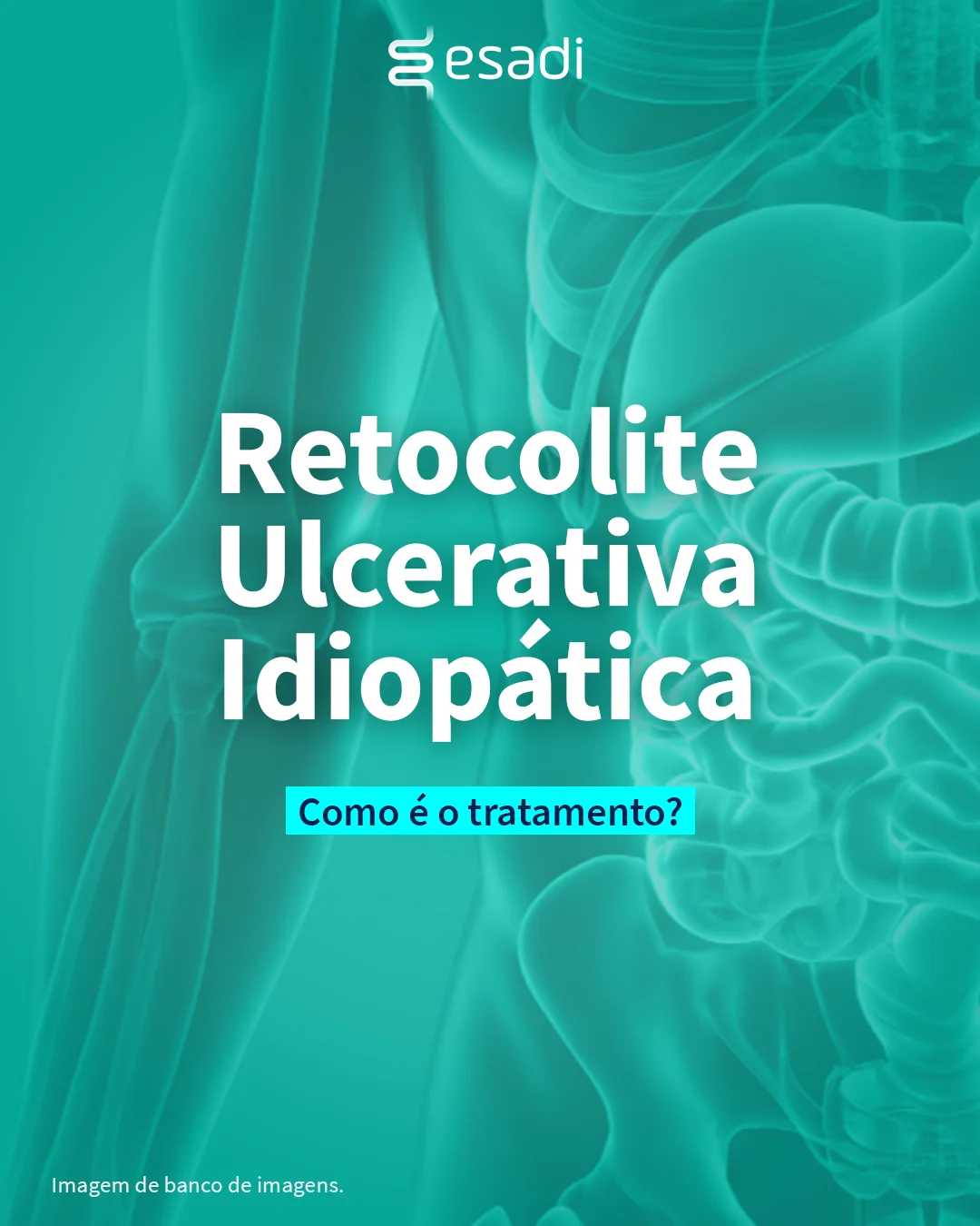 Retocolite ulcerativa idiopática - Como é o tratamento?