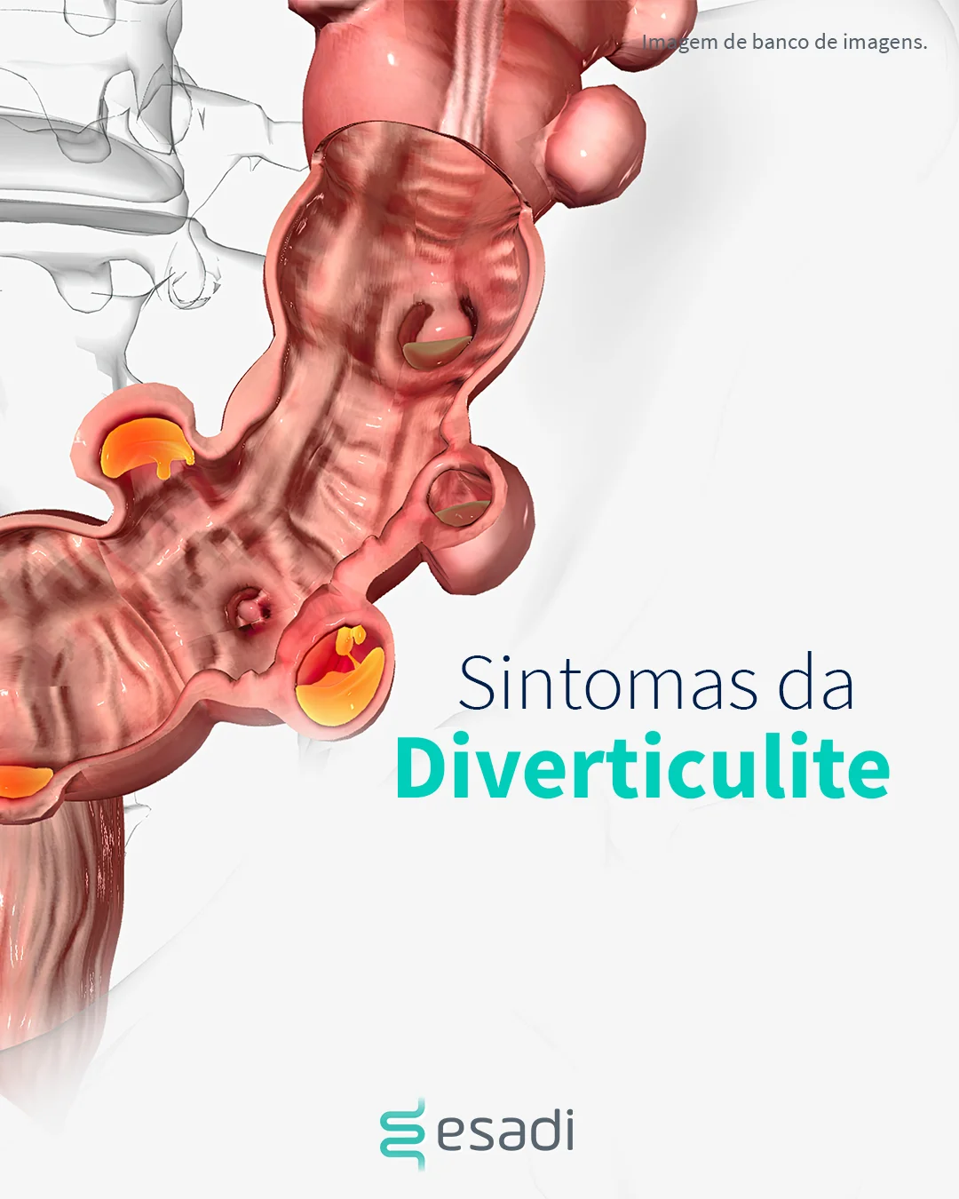 Sintomas de Diverticulite