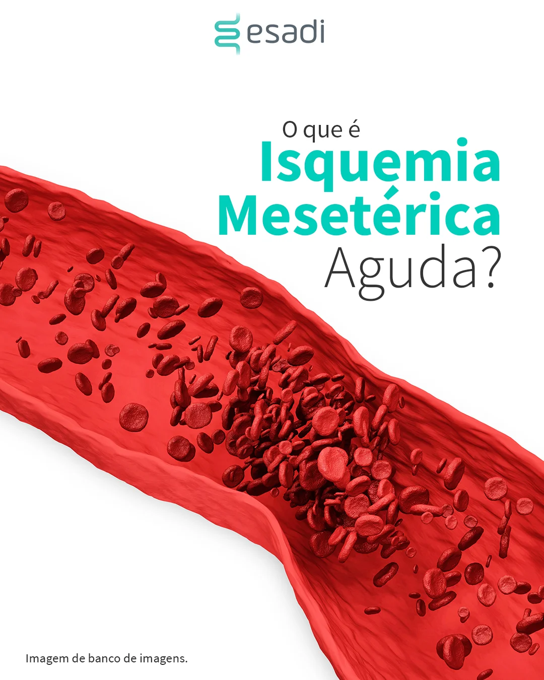 O que é Isquemia Mesentérica Aguda