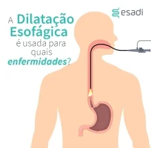 A dilatação esofágica é usada para diagnosticar quais doenças?